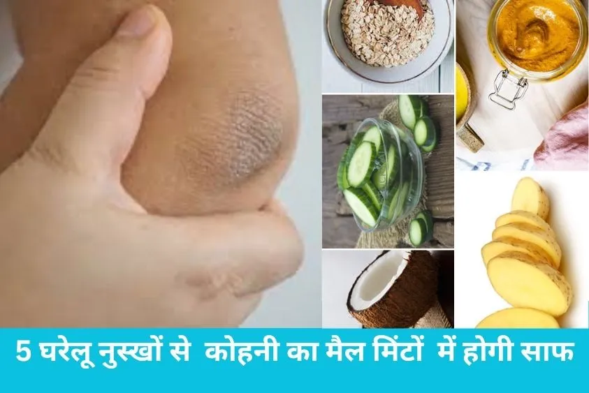  कोहनी के जिद्दी कालेपन से हैं परेशान? इन 5 घरेलू नुस्खों से मिंटों में चमकेगी त्वचा