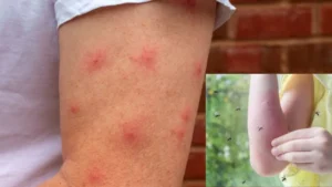 Health Tips: क्या आप जानते हैं? सिर्फ मादा मच्छर ही क्यों पीती हैं इंसानों का खून, जानिए इसकी दिलचस्प वैज्ञानिक वजह