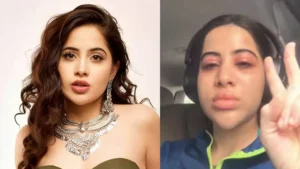 Urfi Javed Allergy: उर्फी जावेद की फिर बिगड़ी हालत, चेहरे पर आई भारी सूजन, फोटो शेयर कर दिखाया एलर्जी का दर्द