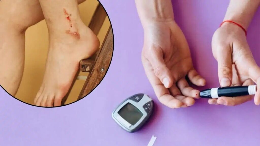 Diabetes Wound Healing Care: डायबिटीज में छोटी सी चोट भी क्यों बन जाती है जानलेवा? जानें एक्सपर्ट डॉक्टर की चेतावनी