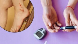 Diabetes Wound Healing Care: डायबिटीज में छोटी सी चोट भी क्यों बन जाती है जानलेवा? जानें एक्सपर्ट डॉक्टर की चेतावनी